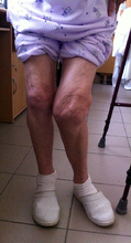 Súlyos rheumatoid arthritises térd a műtét előtt